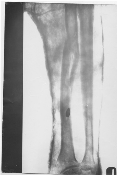 Photo:X Ray of PO GL Bateman's right arm